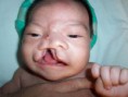 /album/fotogaleria/el-sindrome-de-edwards-tambien-conocido-como-trisomia-18-jpg/